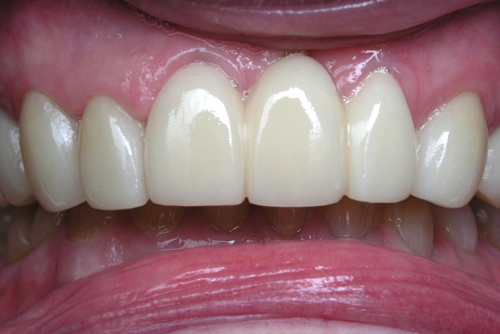 After Dental Bridges