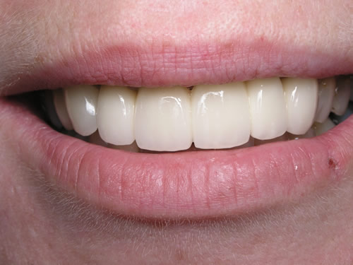 After Dental Bridges
