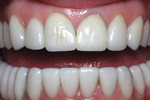After Dental Crowns
