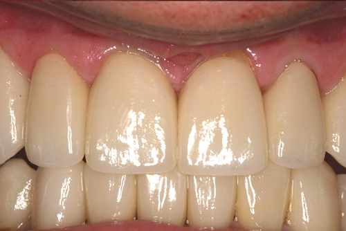 After Dental Crowns