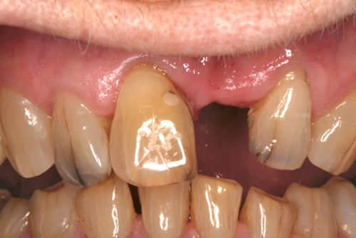 Before Dental Bridges