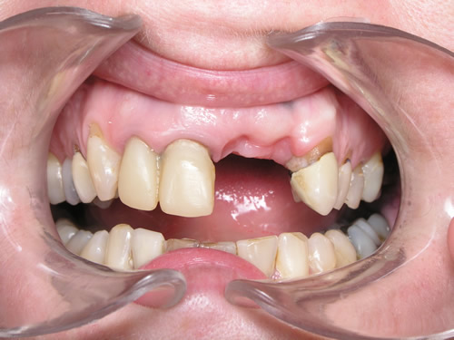 Before Dental Bridges