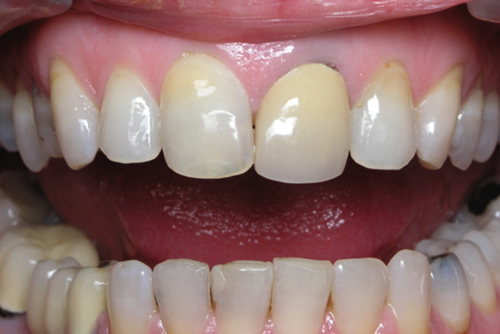 Before Dental Crowns
