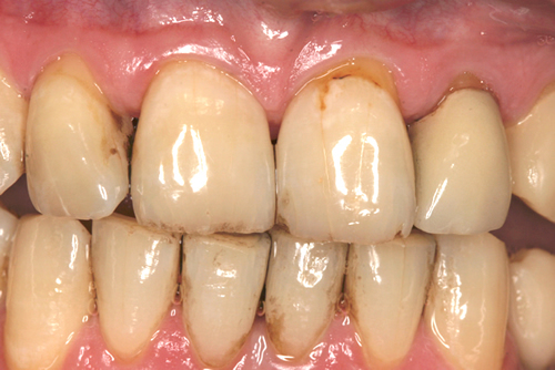 Before Dental Crowns