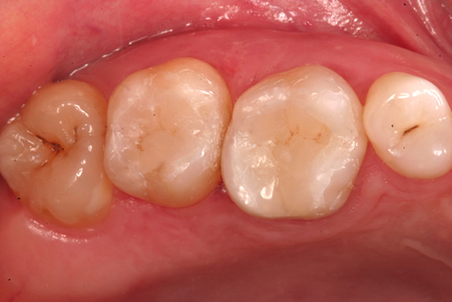 After White Fillings