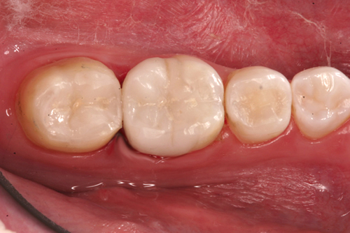 After White Fillings