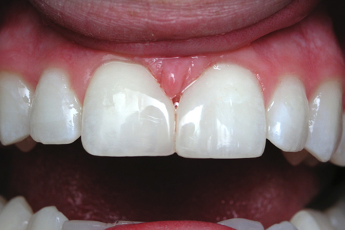 After White Fillings