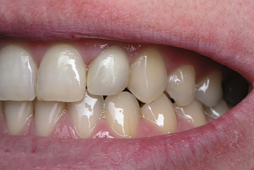 After White Fillings