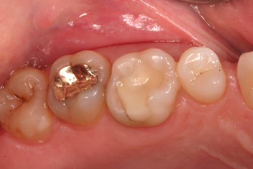 Before White Fillings