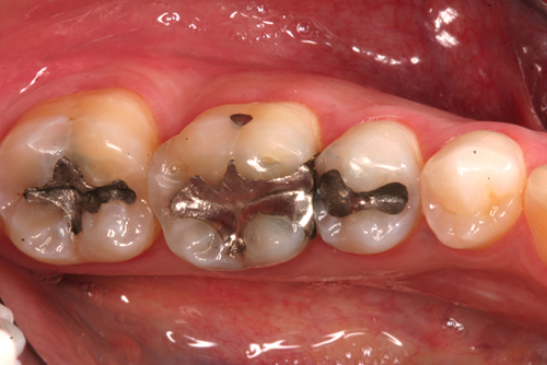 Before White Fillings