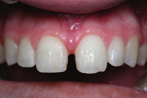Before White Fillings