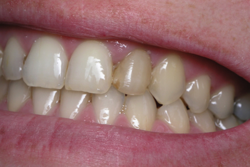 Before White Fillings