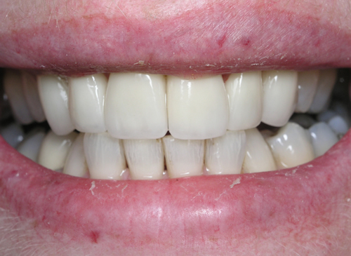 After Instant Orthodontics