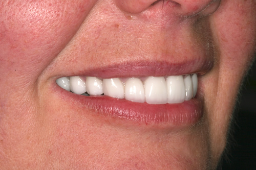 Smile Gallery Case Study After Treatment