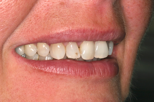 Smile Gallery Case Study Before Treatment