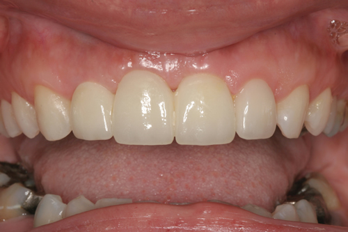 Smile Gallery Case Study After Treatment