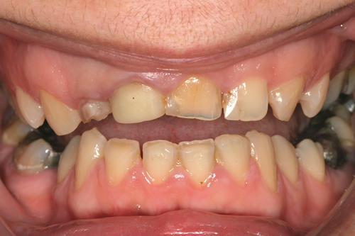 Smile Gallery Case Study Before Treatment