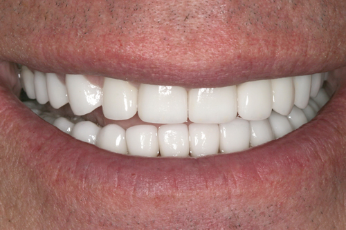 Smile Gallery Case Study After Treatment