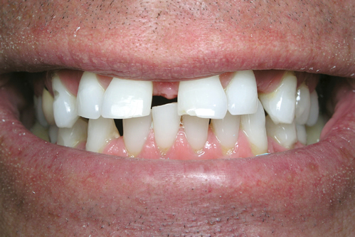 Smile Gallery Case Study Before Treatment