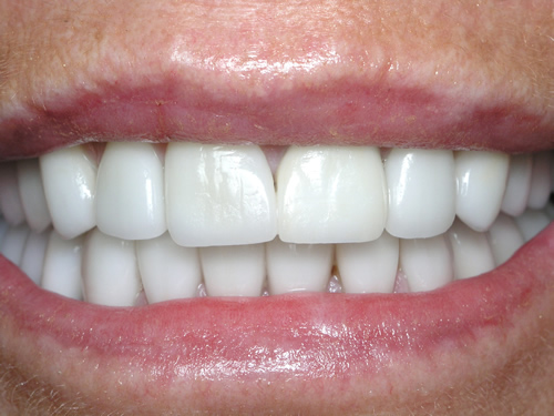 Smile Gallery Case Study After Treatment