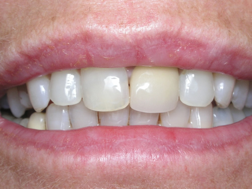 Smile Gallery Case Study Before Treatment
