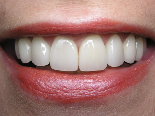 Smile Gallery Case Study After Treatment