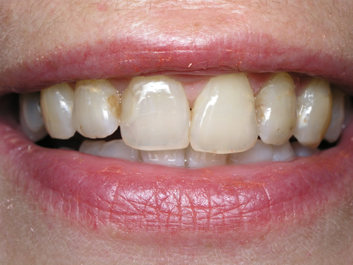 Smile Gallery Case Study Before Treatment