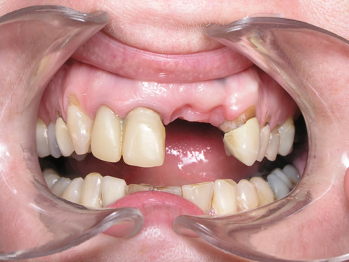 Smile Gallery Case Study Before Treatment