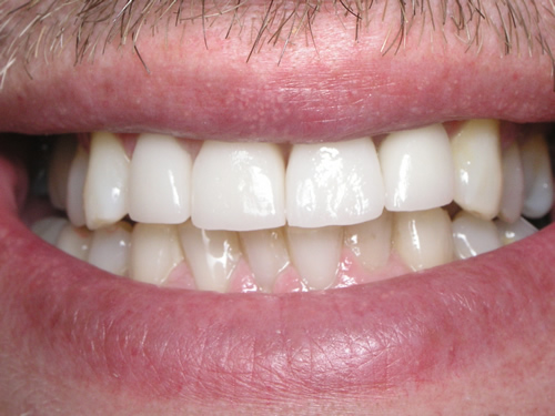 Smile Gallery Case Study After Treatment