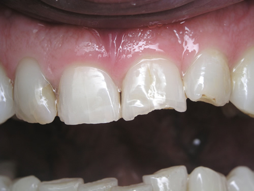 Smile Gallery Case Study Before Treatment