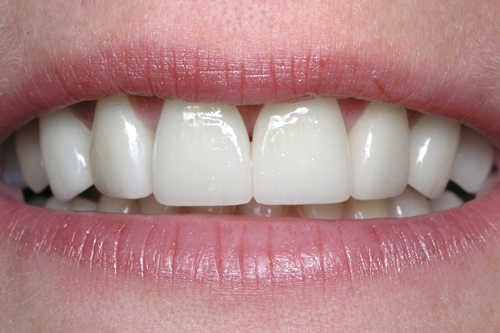 Smile Gallery Case Study After Treatment