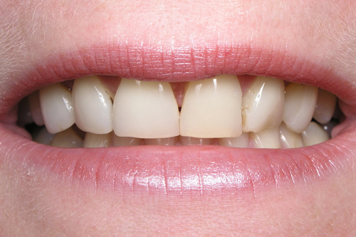 Smile Gallery Case Study Before Treatment