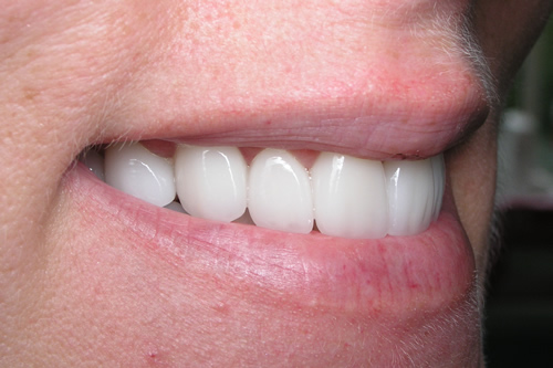 Smile Gallery Case Study After Treatment