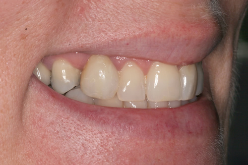 Smile Gallery Case Study Before Treatment