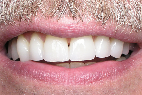 Smile Gallery Case Study After Treatment